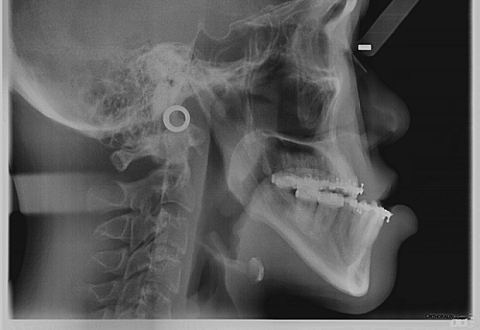Fixing jaw misalignments and deformities